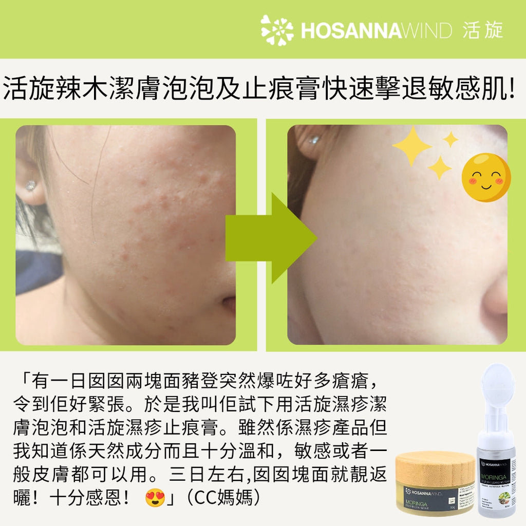 HosannaWind Eczema Cleansing Foam and Ointment effectively fight away allergy.